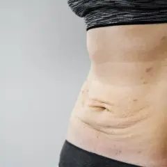 Luźna skóra po schudnięciu 20 kg, widoczne rozstępy i przebarwienia na brzuchu.