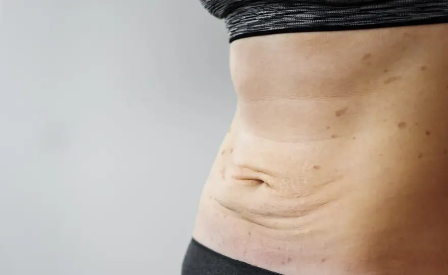 Skóra po schudnięciu 20 kg - Co robić? Plan i porady eksperta